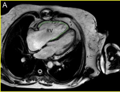 - αορτής Απεικόνιση RVOT και μοσχευμάτων RV-PA Εκτίμηση διαφυγών (shunt lesions) Ανίχνευση