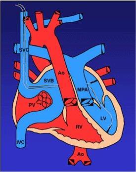 Μετάθεση μεγάλων αγγείων: επεμβάσεις Mustard / Senning (atrial switch) Προβλήματα: δυσλειτουργία συστηματικής RV ανεπάρκεια τριγλώχινας στενώσεις/διαφυγές συστηματικών &