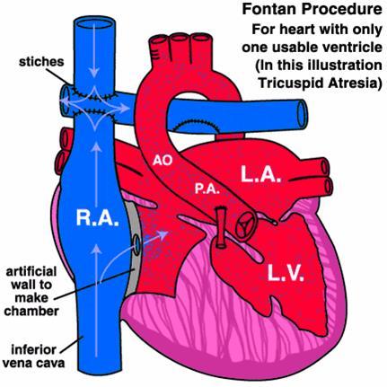Μονήρης κοιλία καί φυσιολογία Fontan Υπερηχογράφημα: συνήθως ικανοποιητικό για απεικόνιση ανατομίας και εκτίμηση καρδιακής λειτουργίας CMR ή CT για πλήρη έλεγχο της πολύπλοκης ανατομίας:
