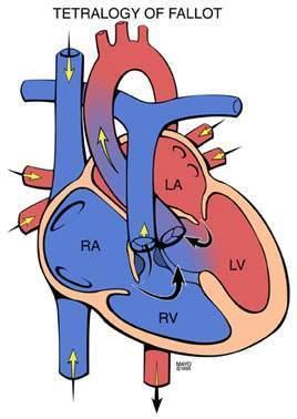 Τετραλογία του Fallot 1. Μεγάλο μεσοκοιλιακό έλλειμμα 2.