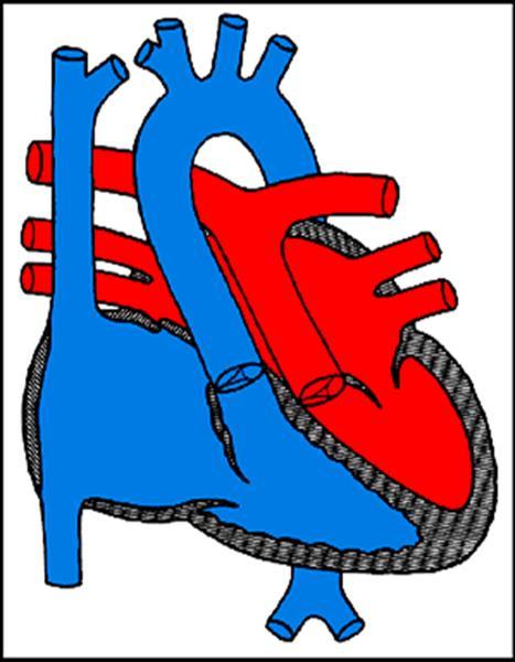 Μετάθεση μεγάλων αγγείων (Transposition of Great Arteries TGA) Αρ. Κοιλία (LV) - οξυγονωμένο αίμα πνευμονική αρτ.