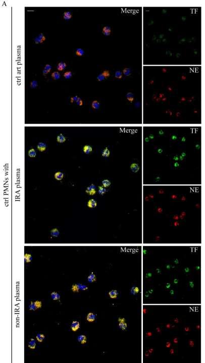 A mechanism for TF-bearing NET release in STEMI A substance