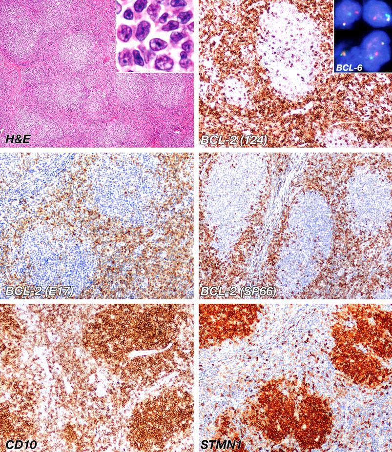 CD10. Οι χρώσεις, BCL-6 και STMN1 εκφράζονται έντονα στους νεοπλασματικούς όζους. Σχήμα 13. Ανοσοφαινοτυπικά και μοριακά χαρακτηριστικά ενός BCL-2-αρνητικού λεμφοζιδιακού λεμφώματος.