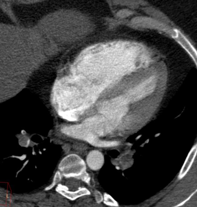 level of the tricuspid and mitral