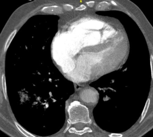 Thromboembolic