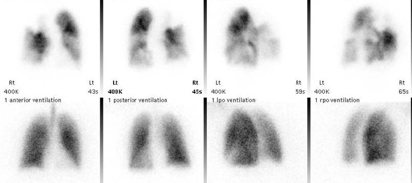 perfusion V/Q