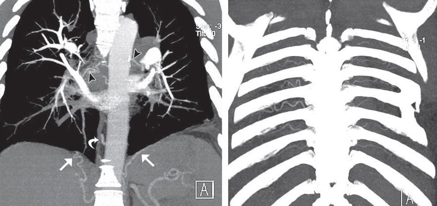 CTEPH Vascular Signs