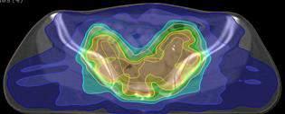 CONCOMITANT RADIOCHEMOTHERAPY LINAC, 18 MV Pelvic RT EBRT 4 fields or IMRT Single dose= 1.8 Gy Overall dose= 45 Gy 1. Brachytherapy 2.