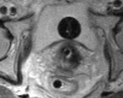 Image-Guided Adaptive Radiotherapy for Cervical Cancer Limitations of 2D X-ray based BT: Point A!