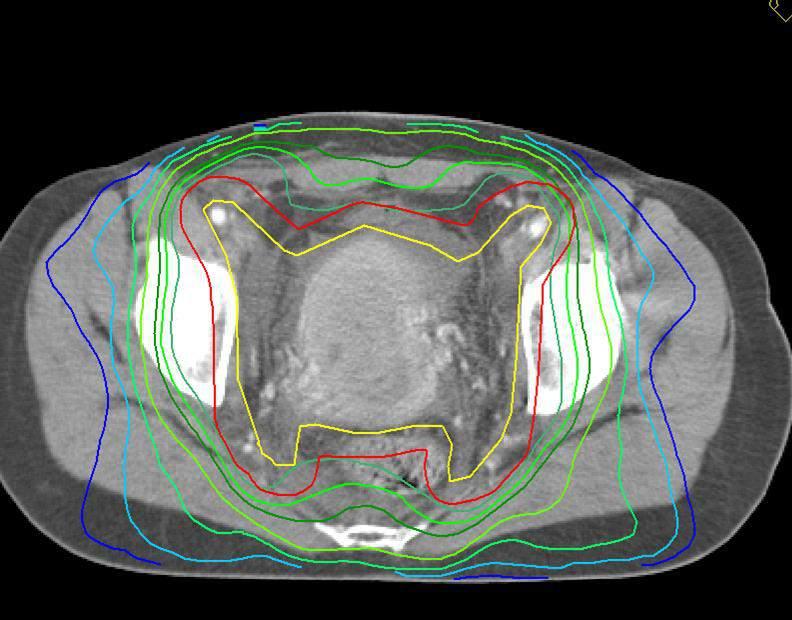 TUMOR REGRESSION WHAT IS HAPPENING DURING