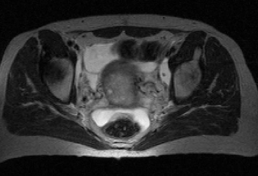 TUMOR REGRESSION WHAT IS HAPPENING DURING