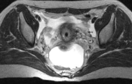 TUMOR REGRESSION WHAT IS HAPPENING