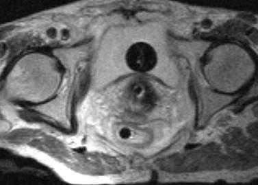 GTV R C Time of brachytherapy B