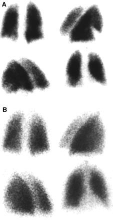 Ασθενής 35 ετών με οξεία δύσπνοια και πλευριτικό άλγος (A) Σπινθηρογράφημα αιμάτωσης πνευμόνων (B) Σπινθηρογράφημα αερισμού πνευμόνων: