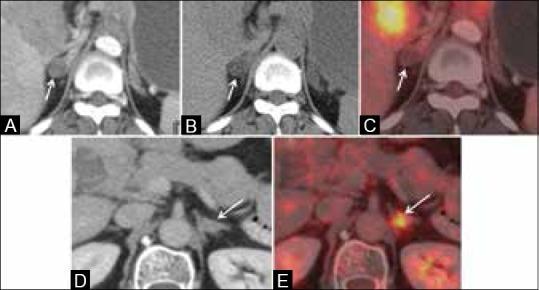 ΚΑΡΚΙΝΟΣ ΠΝΕΥΜΟΝΑ Ασθενής #1 με καρκίνο πνεύμονα (A,Β) Αξονική τομογραφία (C) PET/CT απεικόνιση αρνητική Αδένωμα επινεφριδίου Ασθενής #2 με καρκίνο πνεύμονα (D) Αξονική τομογραφία Source: Purandare