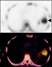 CT NSCLC FDG-PET