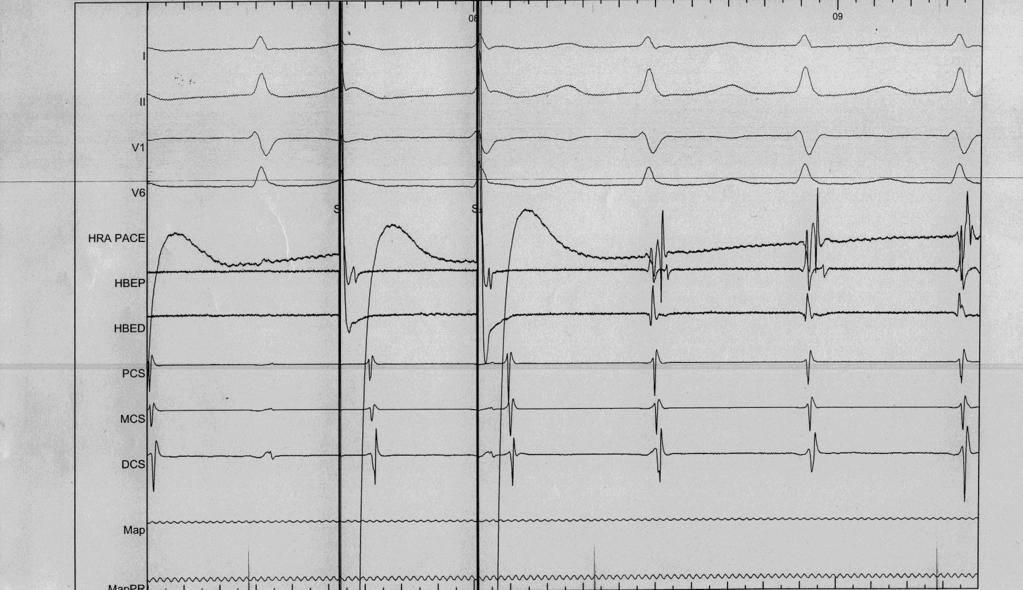 TYPICAL AVNRT INDUCTION