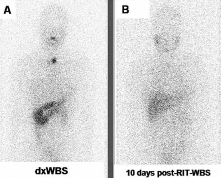 (A) 131I dxwbs (B) Μεταθεραπευτικό WBS Source: Etchebehere EC, et al.