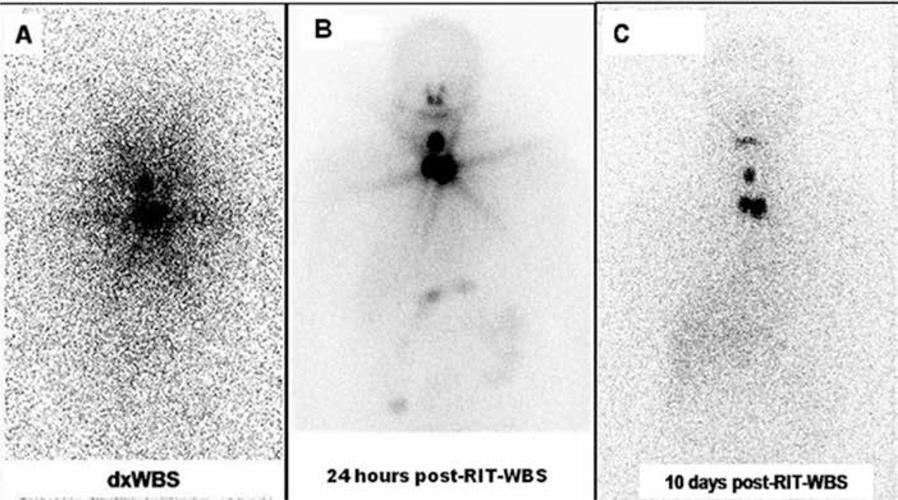 (A) 131I dxwbs (B) WBS 24h (C) WBS 10d Source: Etchebehere EC, et al.