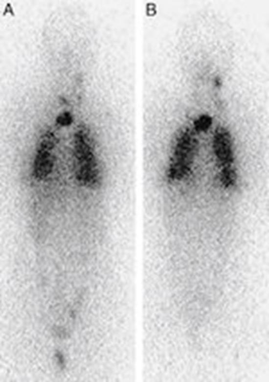 thyroid carcinoma and evaluation of response to