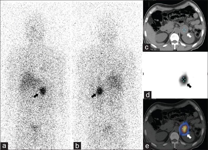 Φαιοχρωμοκύττωμα (A) Planar MIBG anterior (B) Planar MIBG posterior (C) CT (D) SPECT (E) SPECT/CT Source: Sharma P, Kumar R.