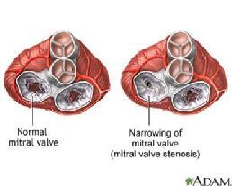 Αίτια Κάθε παθολογική κατάσταση η οποία μπορεί να περιορίσει την απρόσκοπτη κίνηση του αίματος από τον αριστερό κόλπο προς την αριστερή κοιλία αποτελεί εν δυνάμει αίτιο στένωσης της μιτροειδούς