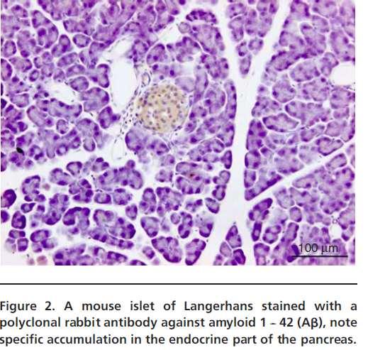 Presentation title Date 32 Κοινά σημεία μεταξύ Alzheimer Disease (AD) και ΣΔ Συγκέντρωση αμυλοειδούς στον εγκέφαλο και το πάγκρεας Το