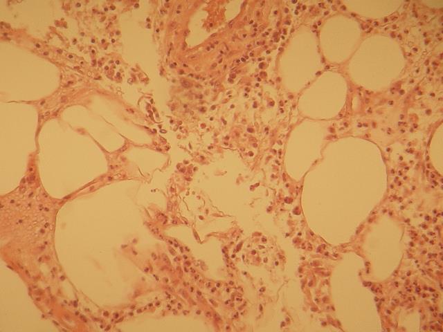 Αναγνωρίστηκαν δυο μικρά μη νεκρωτικά επιθηλιοειδή κοκκιώματα, παρουσία λίγων πολυπύρηνων γιγαντοκυττάρων και αιμορρα-γικές διηθήσεις