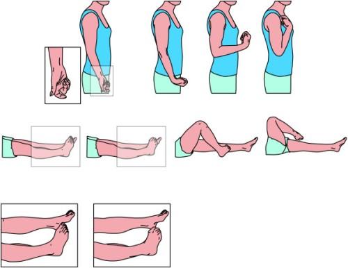 έχουν κληρονομική προδιάθεση. Συμπτώματα δυστονίας Ακούσιες μυϊκές συσπάσεις που προκαλούν επαναλαμβανόμενες κινήσεις ή παραμορφωμένη στάση. Συνήθως ξεκινά από το πόδι, το χέρι ή τον λαιμό.