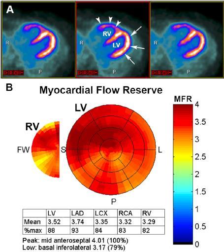 PET- 82 Rb Myocardial Perfusion Imaging- MBF/MFR Gold standard ( 82 rubidium, 13 N-ammonia or 15 O-water) - Ποσοτικοποίηση μυοκαρδιακής ροής αίματος (MBF ml/g/min) -