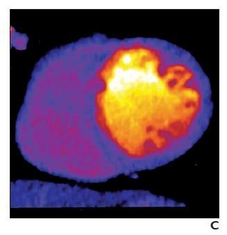 Dual Energy CT Rest Stress Akos