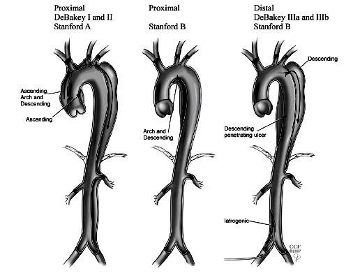 Η πιο απλή ταξινόμηση είναι αυτή κατά Stanford, όπου Α: στον διαχωρισμό συμμετέχει η ανιούσα αορτή και Β: δεν συμμετέχει η ανιούσα.