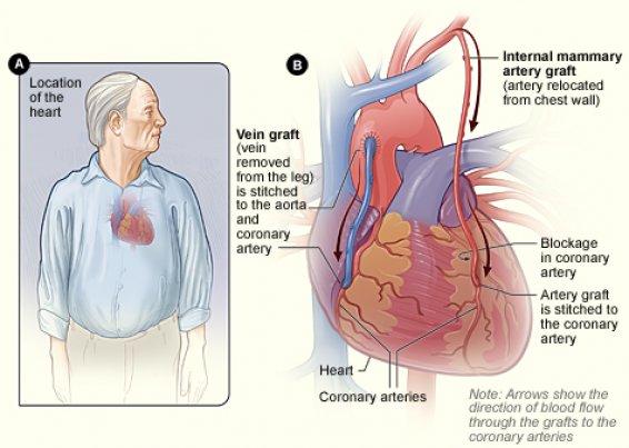 CABG