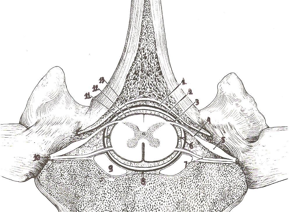 Εικόνα 1. Σχηματική παράσταση της διατάξεως των μηνίγγων του νωτιαίου μυελού. 1, επισκληρίδιος χώρος. 2, σκληρή μήνιγγα. 3, υποσκληρίδιος χώρος. 4, ραχιαία ρίζα νωτιαίου νεύρου. 5, νωτιαίο γάγγλιο.