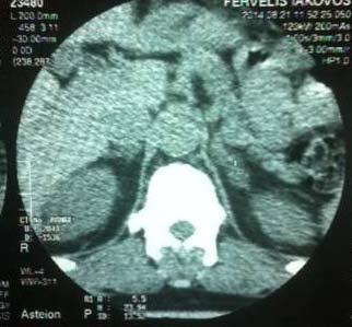 Διενέργεια CT επινεφριδίων Οζιδιακή διαμόρφωση του έσω