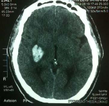 2 ημέρες μετά διενεργείται 2 η CT εγκεφάλου Επανελέγχεται η γνωστή αιμορραγική εστία στα βασικά γάγγλια ΔΕ, χωρίς αξιόλογη μεταβολή των