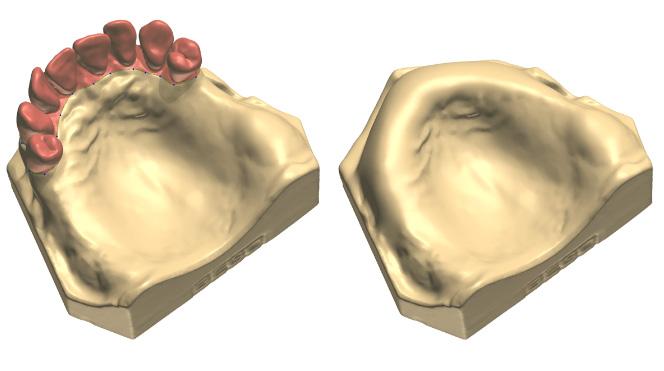 Δόντια προσαρμοσμένα βάσει φρεζαρίσματος ή εκτύπωσης Διαθέσιμο με το Dental System 20