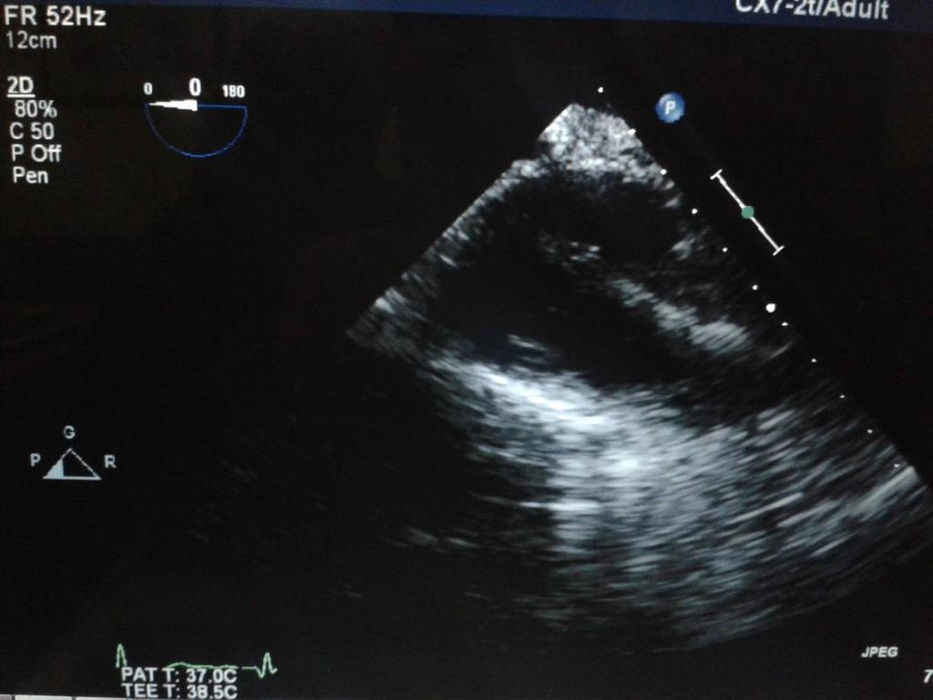 Cardioverter defibrillator implantation in a pregnant woman guided with transesophageal echocardiography.