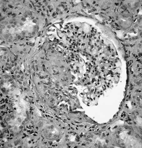 P. Pateinakis et al. Ελληνική Νεφρολογία, 29, 2017 Figure 2. Glomerulus showing focal necrosis and a cellular crescent (PAS X 400). his creatinine started to decline gradually, reaching 1.