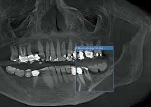 [ ACRYLINE X-Ray ] Ακτινοσκιερό ακρυλικό κατάλληλο για ακτινοδιάγνωση στην Εμφυτευματολογία μέσω αξονικής τομογραφίας