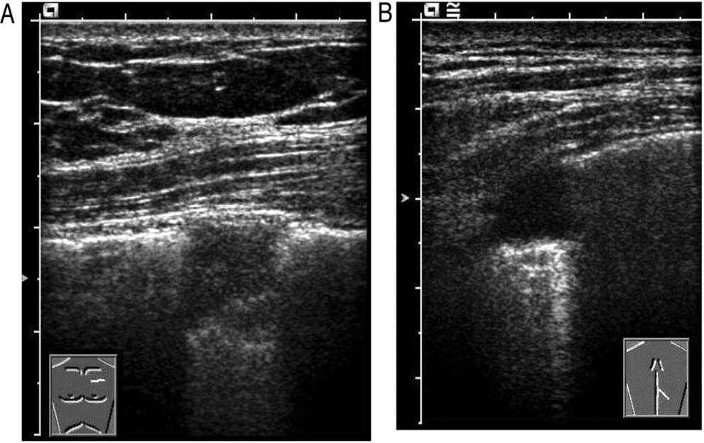 Thoracic Ultrasound for Diagnosing Pulmonary Embolism * : A Prospective