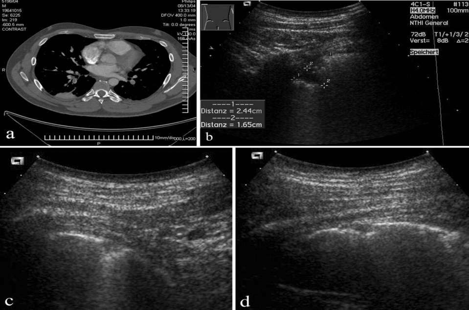 Thoracic Ultrasound for Diagnosing Pulmonary Embolism * : A Prospective