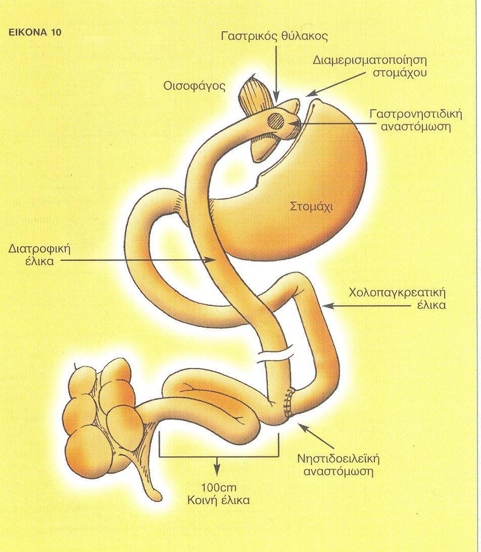 Μικτές βαριατρικές επεμβάσεις Οι διάφοροι τύποι μικτων επεμβάσεων διαφέρουν ως προς το μεγεθος του γαστρικου θυλάκου και τα