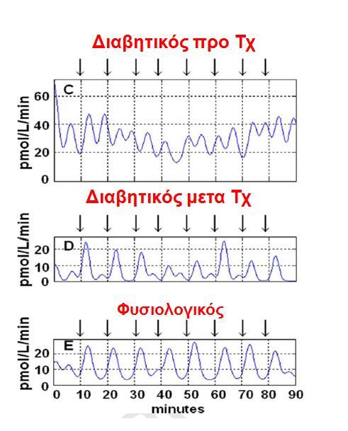 Βασικη παλμική έκκριση ινσουλίνης σε διαβητικούς ασθενείς πριν και μετα BPD