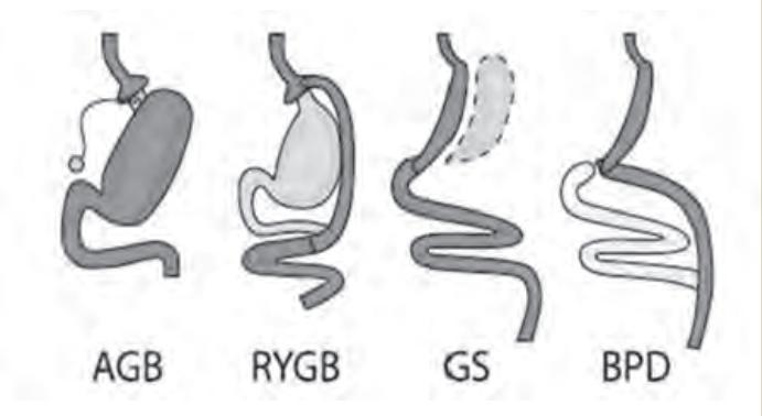 Είδη βαριατρικής επέμβασης