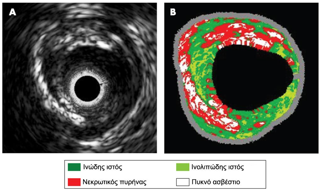 Virtual Histology Tissue components of