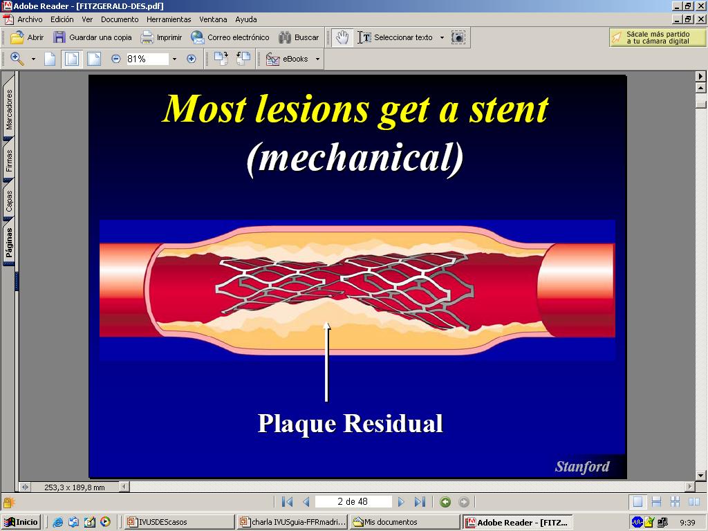 Post-PCI Complications Geogrphic Miss Stent