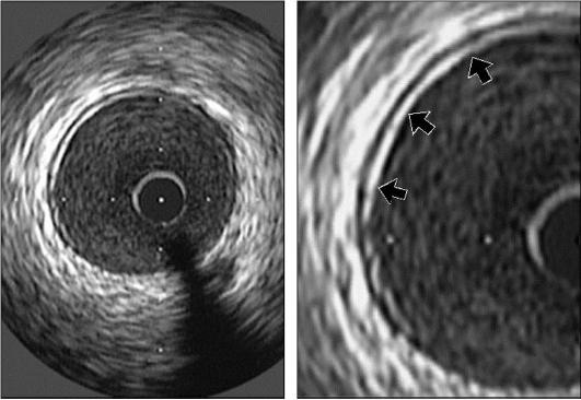 Intravascular Imaging: From sound to