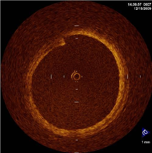 evaluation of lumen dimensions and