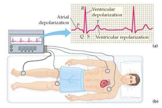 Înregistrare ECG tipică ECGul arată perturbări în activitatea electrica normală a inimii, de exemplu "Inimă blocată", în cazul în care semnalele nodului SA nu sunt conduse